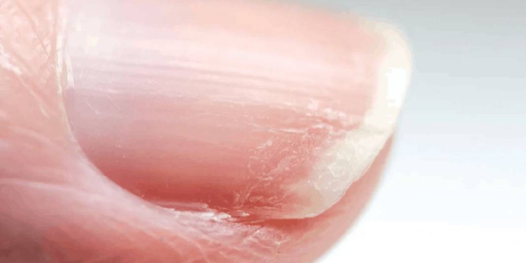 Vitamin eksikliği sandığınız çizgiler ipucu olabilir! Vitamin eksikliği mi, başka bir sorun mu? İşte cevabı… 6